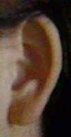 Uterine Fibroid tumor ( myoma ) ear